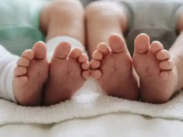Pemulihan Bayi Kembar Siam Pascaoperasi: Perkembangan NA 1 dan NA 2 di RSCM
